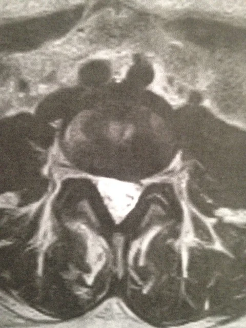 A spinal x-ray after spinal decompression