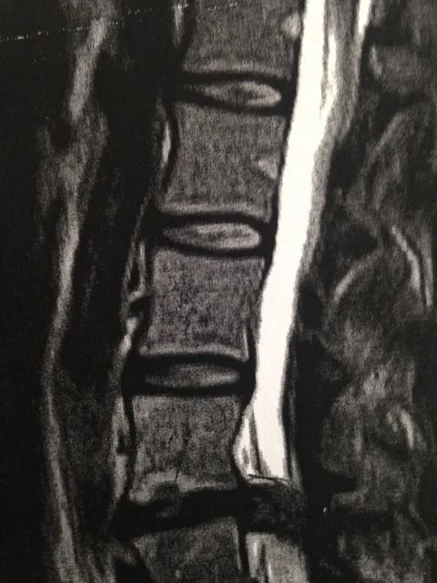 An x-ray of a patient's spine before spinal decompression